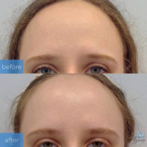 First-Time Dysport Before and After at Azura Skin Care Center Cary NC