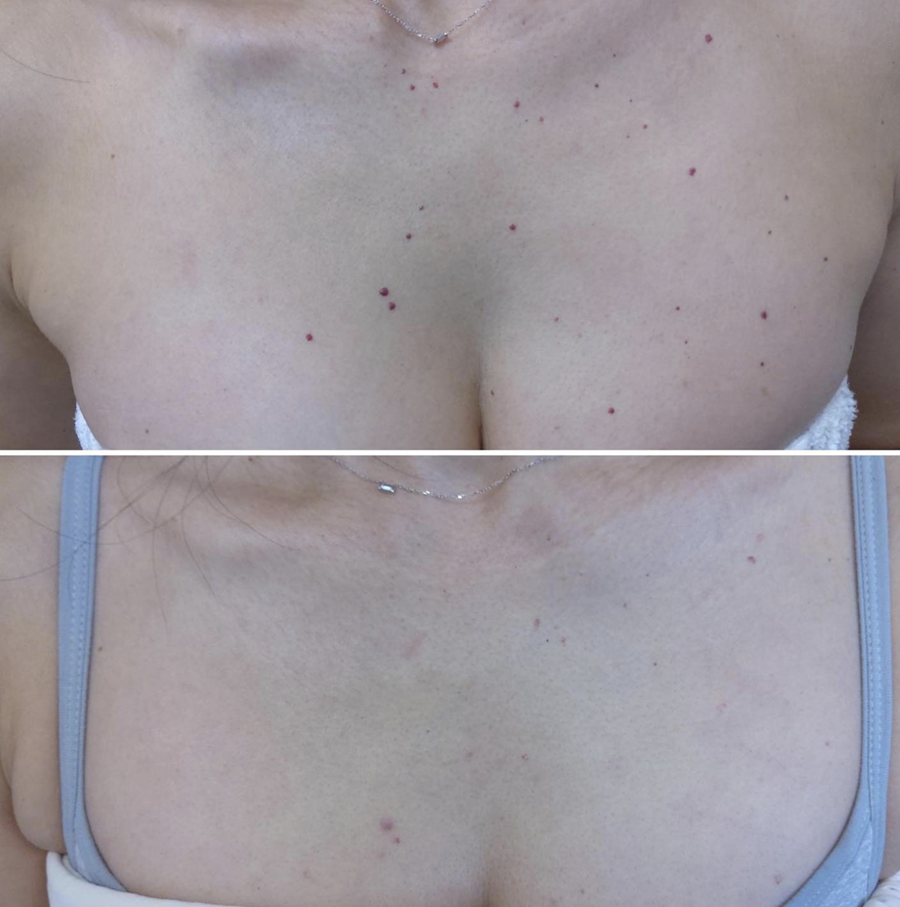Cherry Angiomas at Azura Skin Care Center