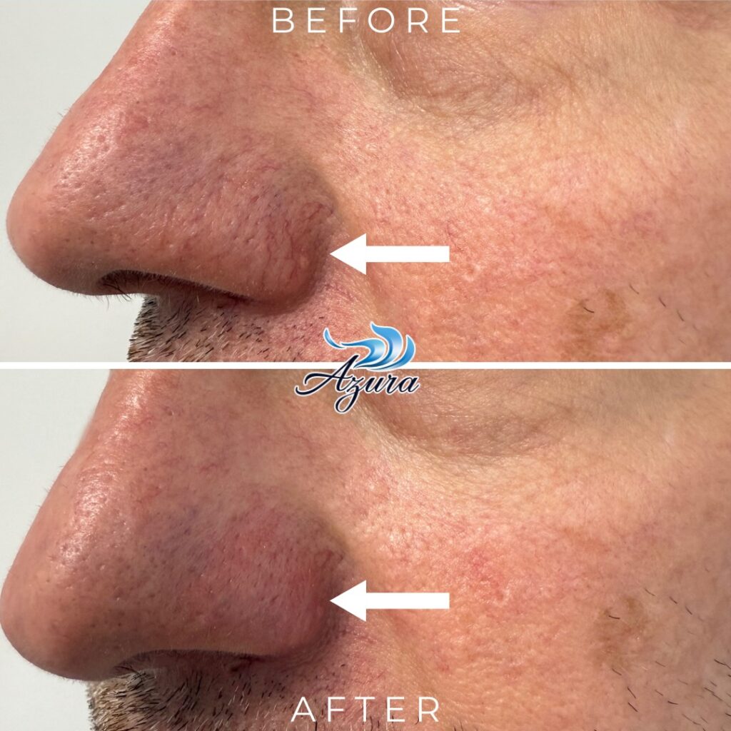 Azura Skin - Facial Veins and Cherry Angioma Correction with Laser Treatment (1)