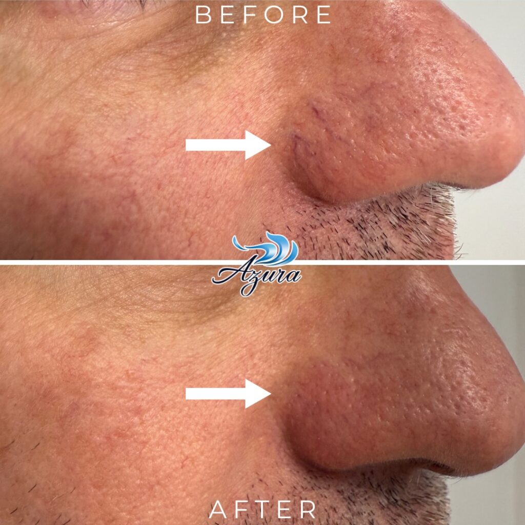 Azura Skin - Facial Veins and Cherry Angioma Correction with Laser Treatment (1)
