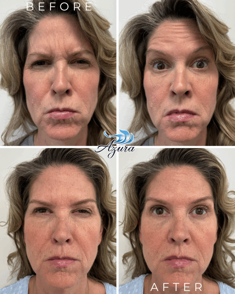 Letybo Before and After at Azura Skin Care Center in Raleigh
