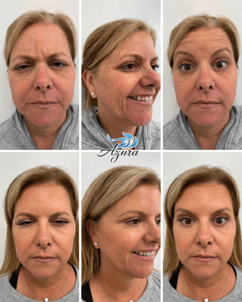 Letybo Before and After at Azura Skin Care Center in Raleigh