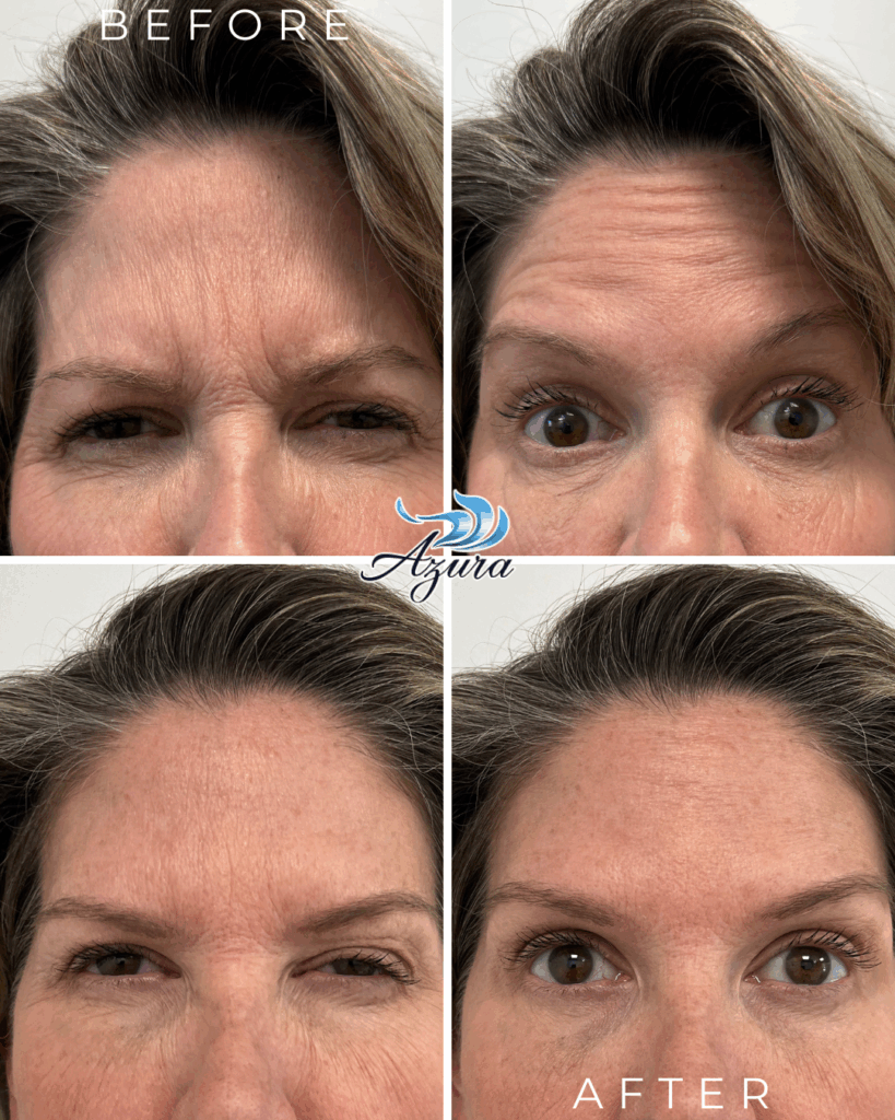 Letybo Before and After at Azura Skin Care Center in Raleigh