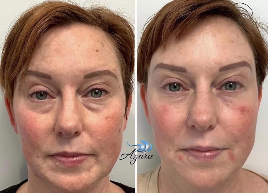 Filler at Azura Skin Care Center