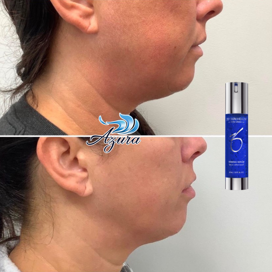 Sofwave and ZO August Special at Azura Skin Care Center