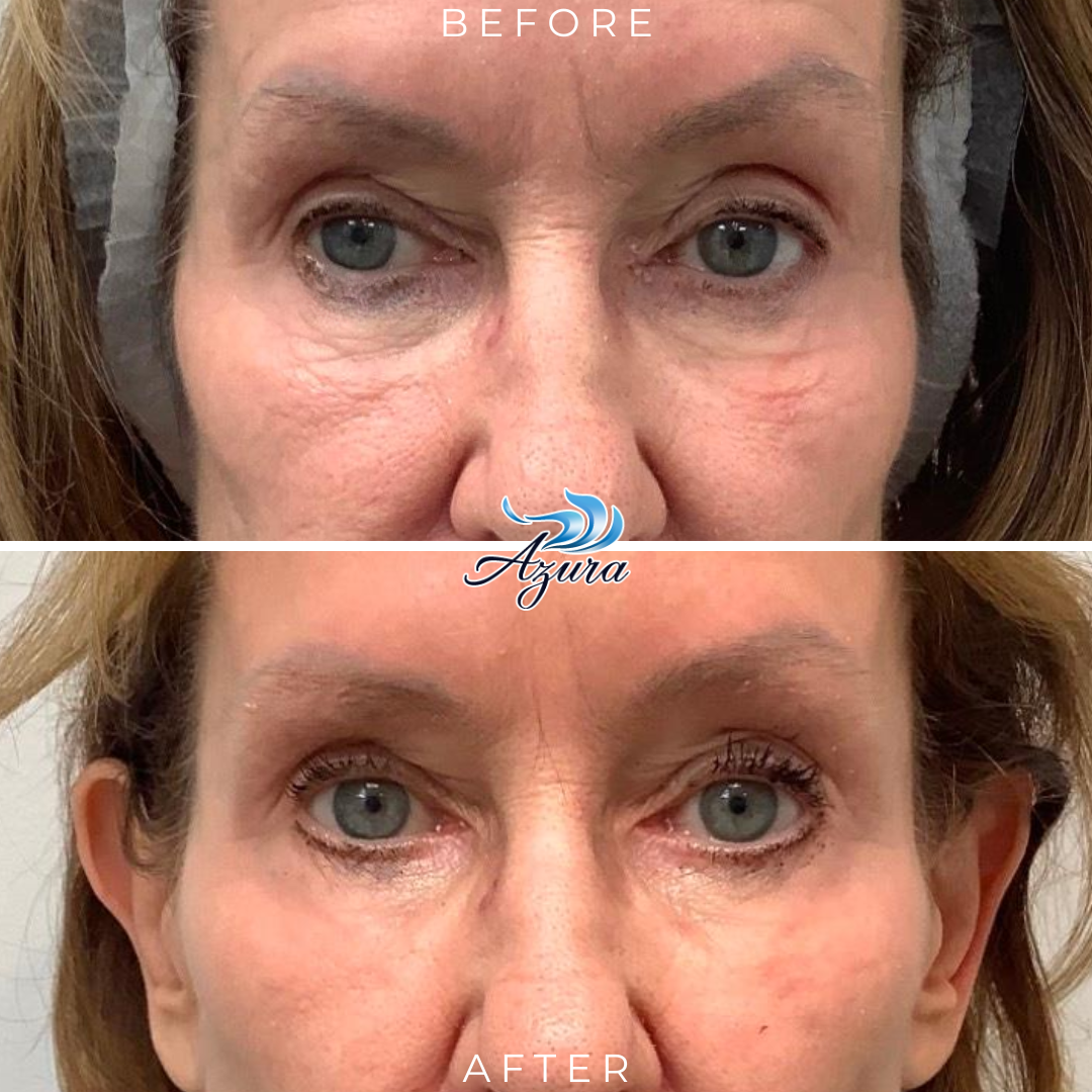 Provoque at Azura Skin Care Center