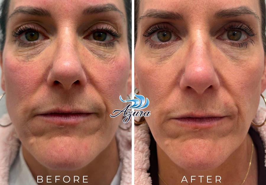Provoque Before and After at Azura