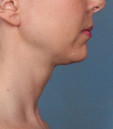 Azura Skin Care Center - Cary, NC - After Kybella Treatment