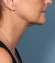 Azura Skin Care Center - Cary, NC - After Kybella