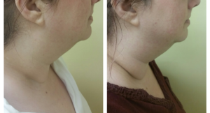 After and before three Exilis treatments lower face and neck