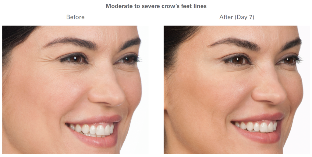 Botox Cosmetic before and after - Azura Skin Care Center - Cary, NC