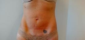 Four Weeks After Fourth Exilis Treatment at Azura Skin Care Center