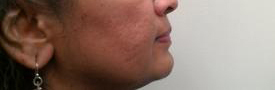 One Month After Second Microneedling at Azura Skin Care Center