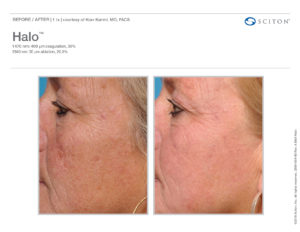 Halo Laser Results - Before and After - Azura Skin Care Center in Cary, NC