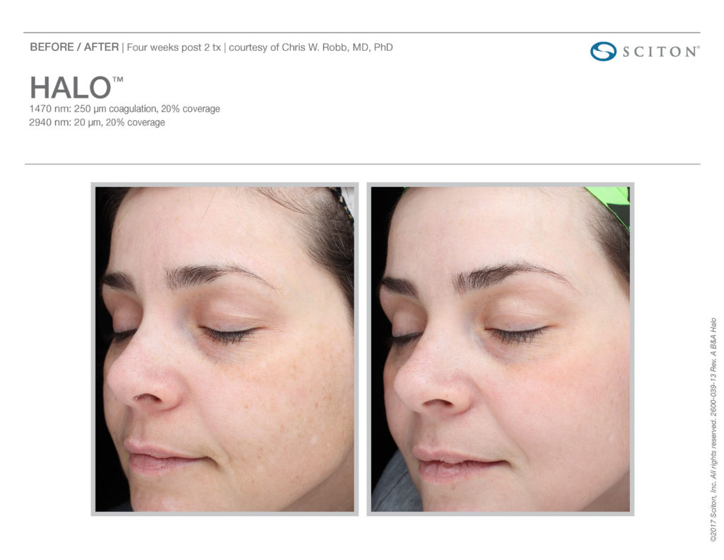 Halo Laser Results - Before and After - Azura Skin Care Center in Cary, NC