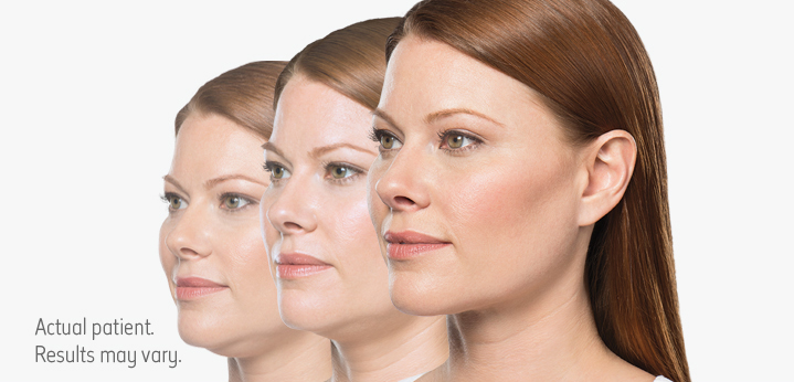 Kybella for Double Chin at Azura Skin Care Center Cary, NC