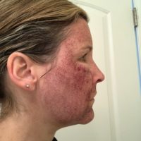 Halo™ Laser Before and After - Azura Skin Care Center - Cary, NC