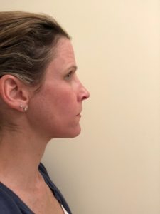 Halo™ Laser Before and After - Azura Skin Care Center - Cary, NC