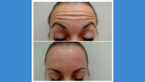 Forehead injectables before and after Azura Skin Care Center