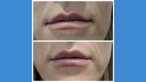 Lip filler before and after Azura Skin Care Center