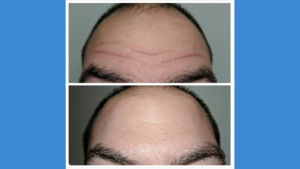 Forehead injectables before and after Azura Skin Care Center