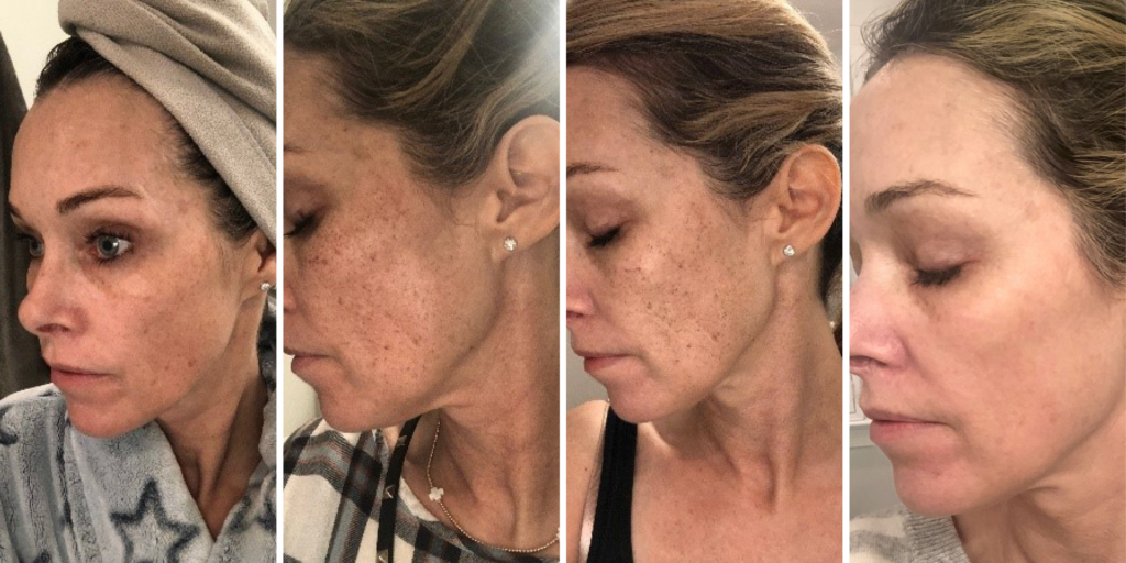 Azura Skin Care Center - Halo - Before and After