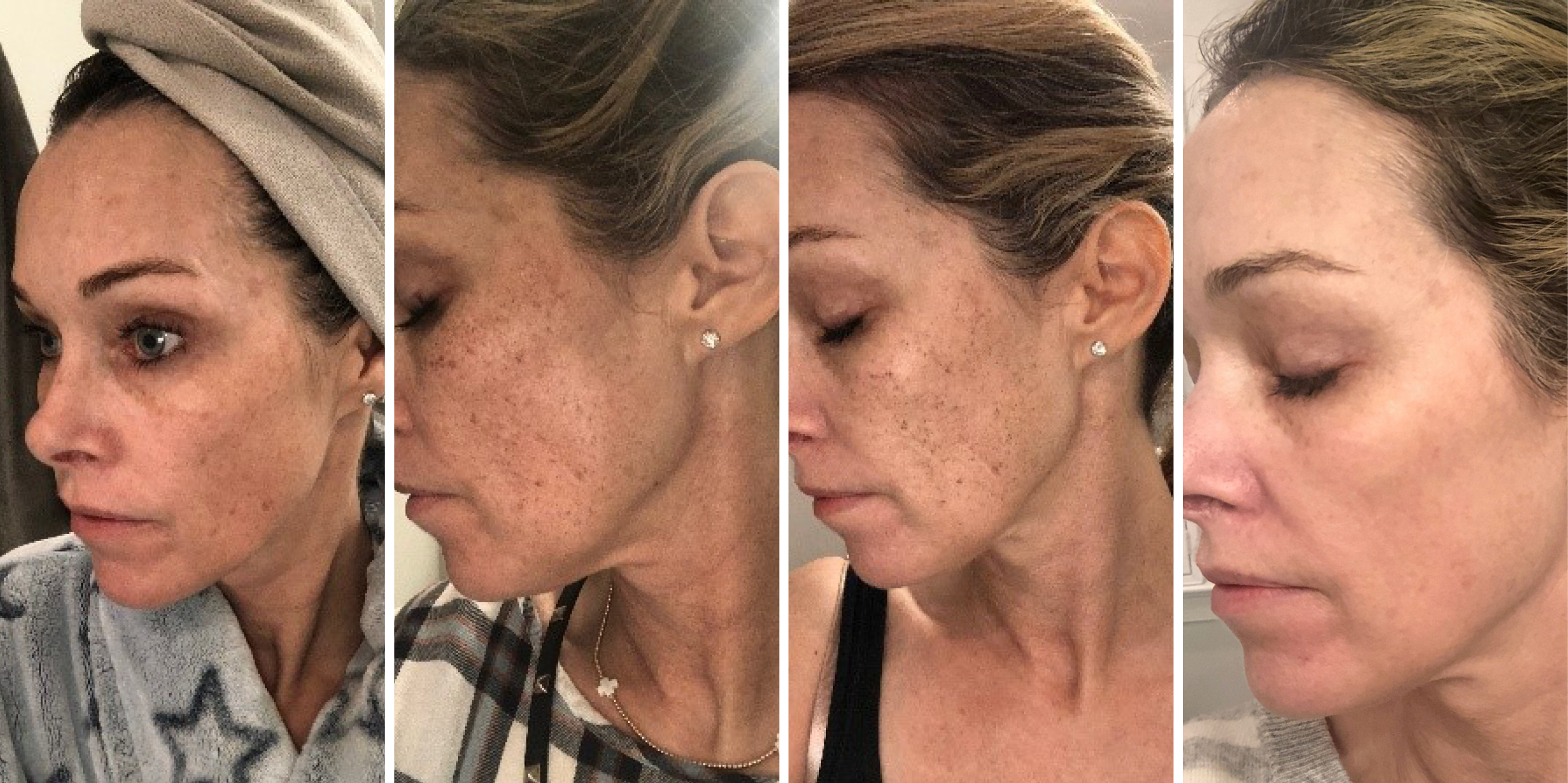 Azura Skin Care Center - Halo - Before and After