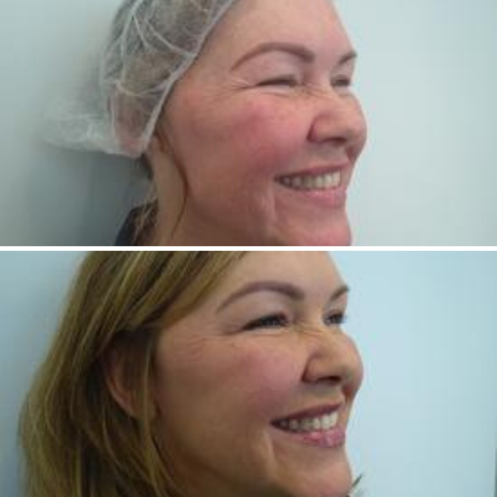 Botox at Azura Before and After