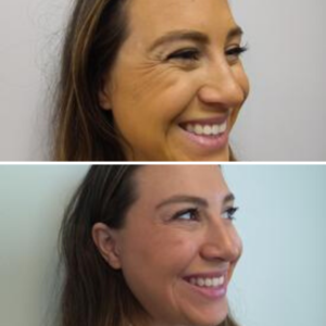 Botox at Azura Before and After