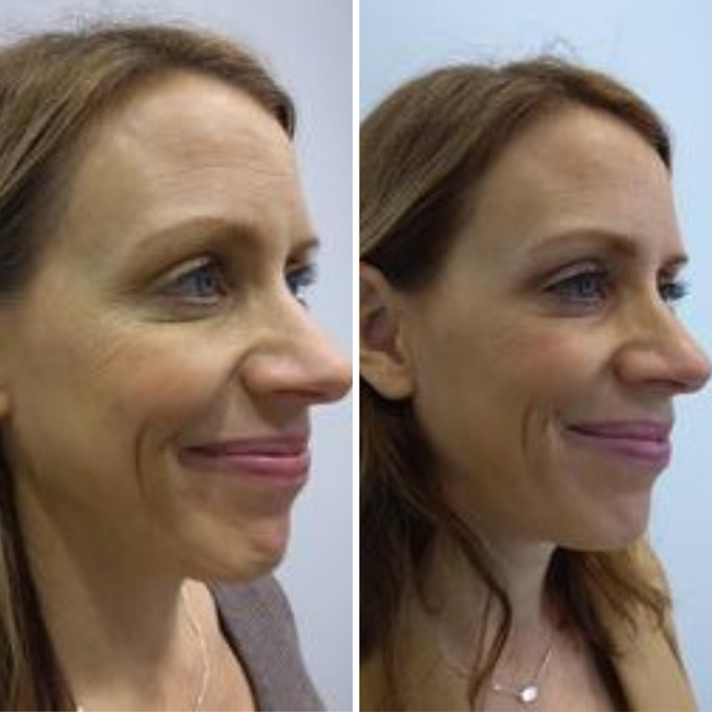 Botox at Azura Before and After