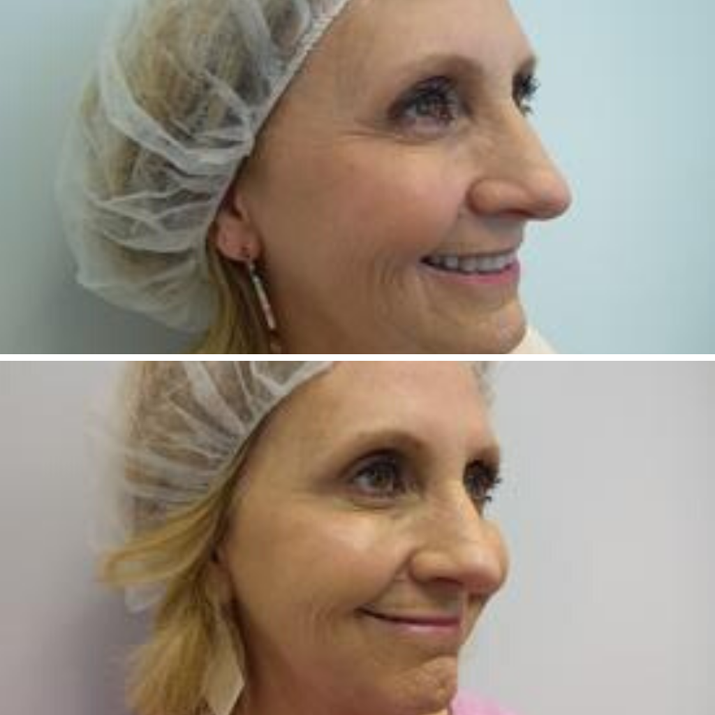 Botox at Azura Before and After