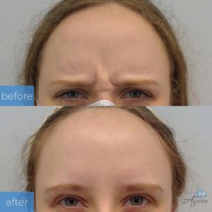 First-Time Dysport Before and After at Azura Skin Care Center Cary NC