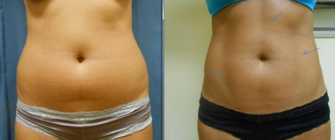 Liposuction Before and After at Azura Skin Care Center Cary NC Dr Tellis Abdomen 02