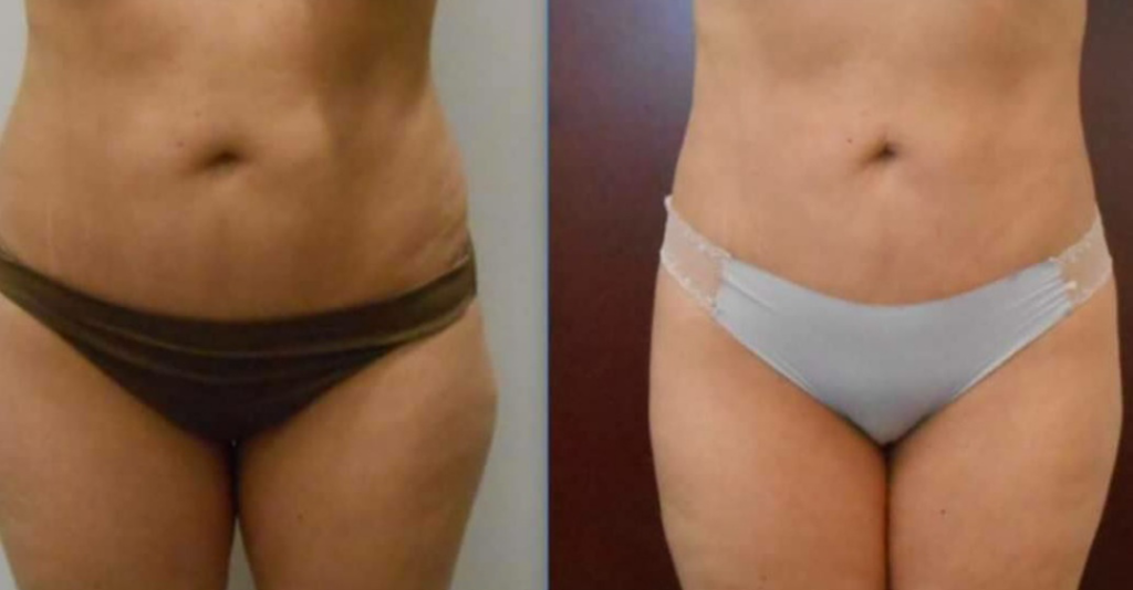 Liposuction Before and After at Azura Skin Care Center Cary NC Dr Tellis Abdomen