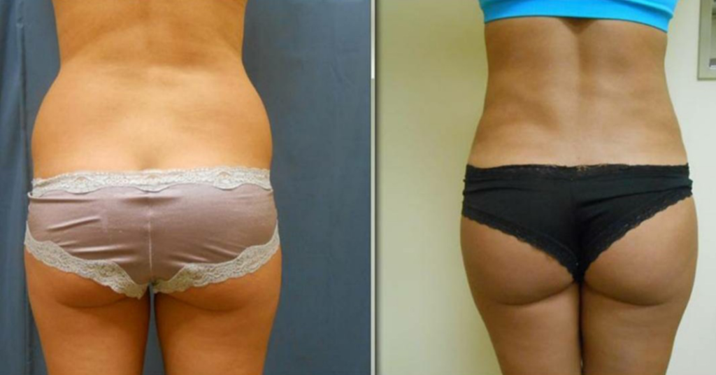 Liposuction Before and After at Azura Skin Care Center Cary NC Dr Tellis Back