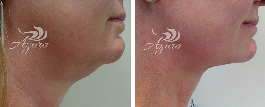 Azura Skin Care Center Kybella Special Offer for February 2021