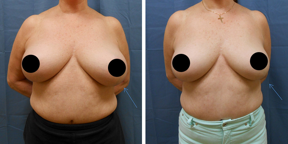 Azura Dr. Tellis Scarless Breast Reduction