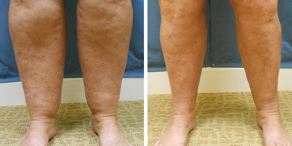 Azura Dr. Tellis Liposuction