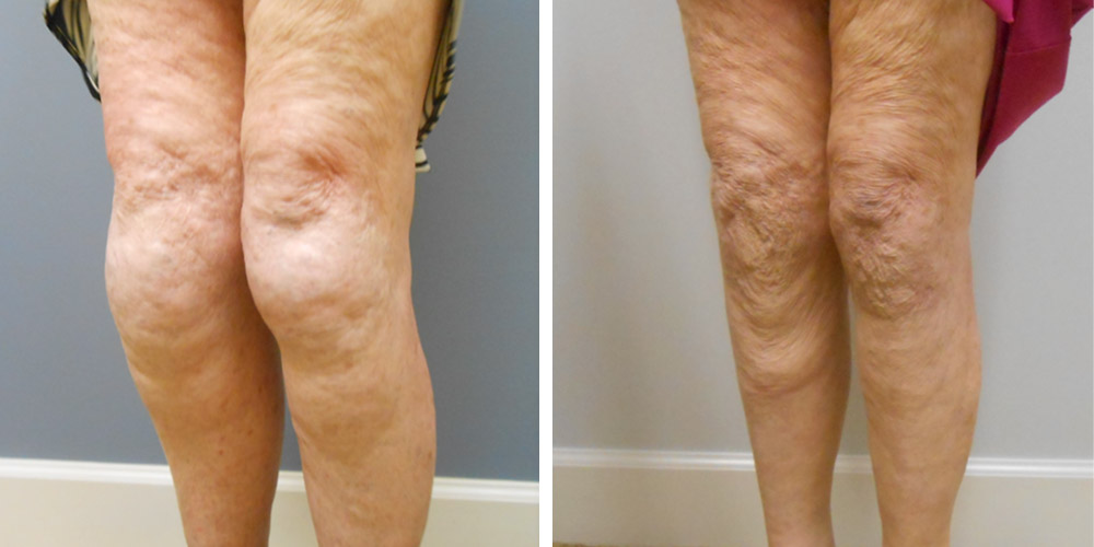 Azura Dr. Tellis Liposuction