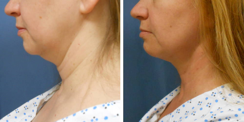 Azura Dr. Tellis Liposuction