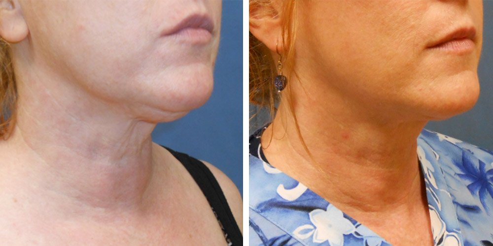 Azura Dr. Tellis Liposuction