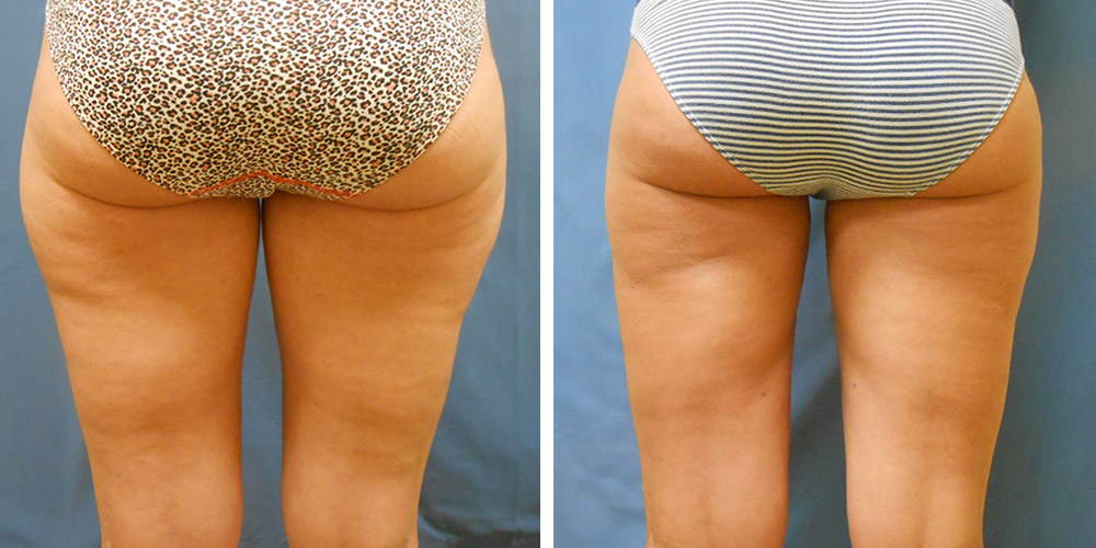 Azura Dr. Tellis Liposuction