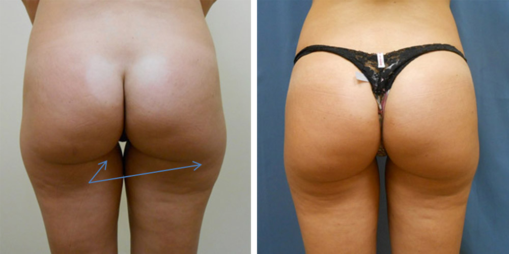 Azura Dr. Tellis Liposuction