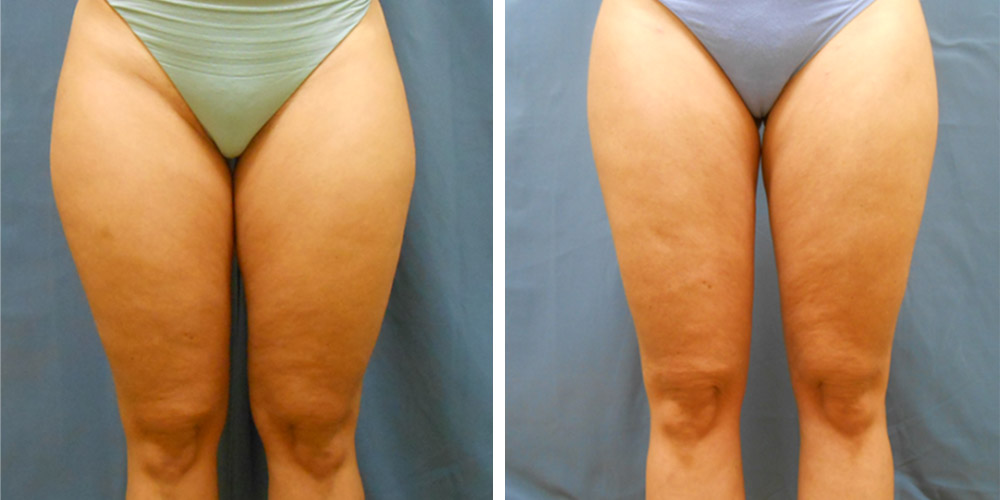 Azura Dr. Tellis Liposuction