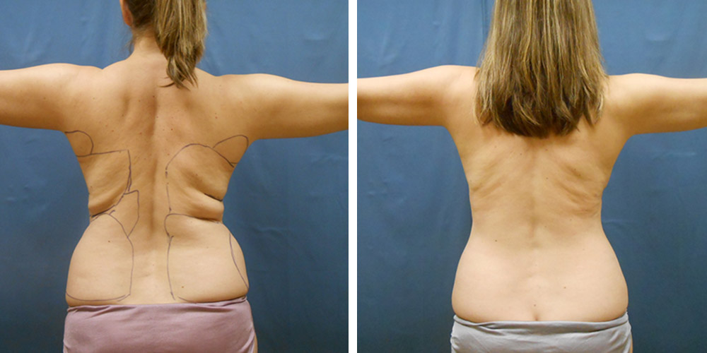 Azura Dr. Tellis Liposuction