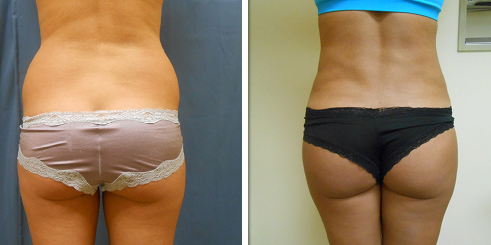 Azura Dr. Tellis Liposuction