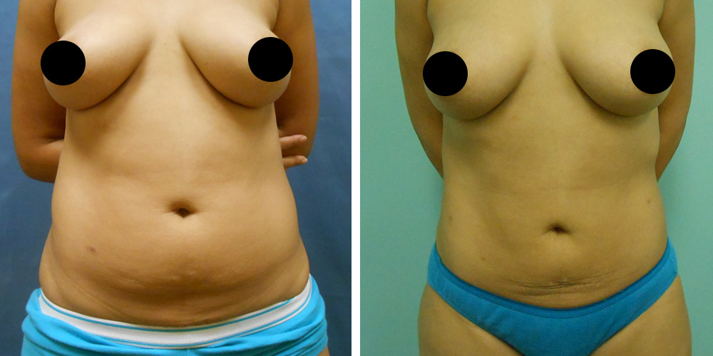 Azura Dr. Tellis Liposuction
