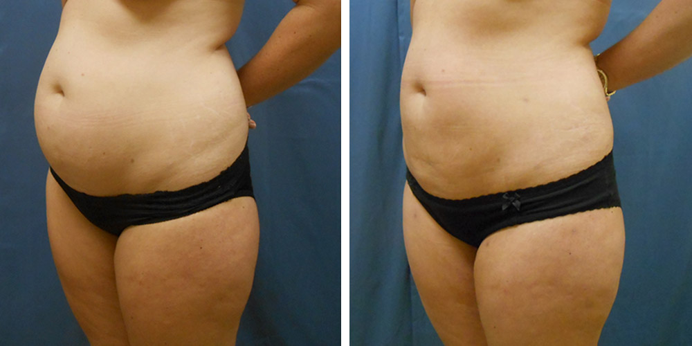 Azura Dr. Tellis Liposuction