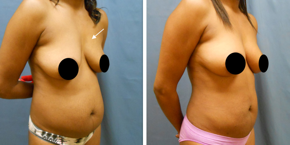 Azura Dr. Tellis Scarless Breast Reduction