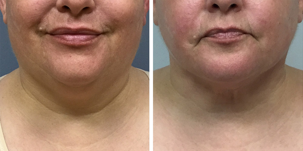 Azura Dr. Tellis Skin Tightening